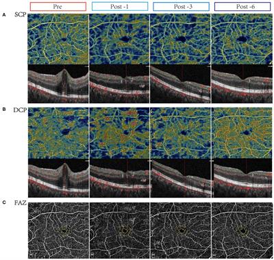 Microvascular Changes After Conbercept Intravitreal Injection of PDR With or Without Center-Involved Diabetic Macular Edema Analyzed by OCTA